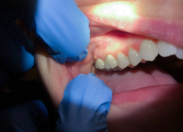 Best Emergency Dental Care for Sports Injuries in Franklin, PA